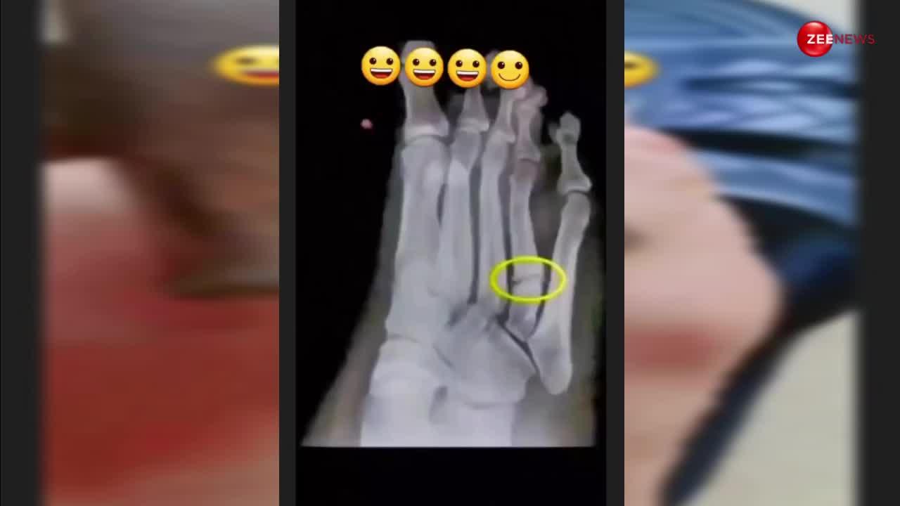 Viral Video: मच्छर को मारने के चक्कर में आदमी ने तोड़ लिया अपना पैर, वीडियो हुआ वायरल